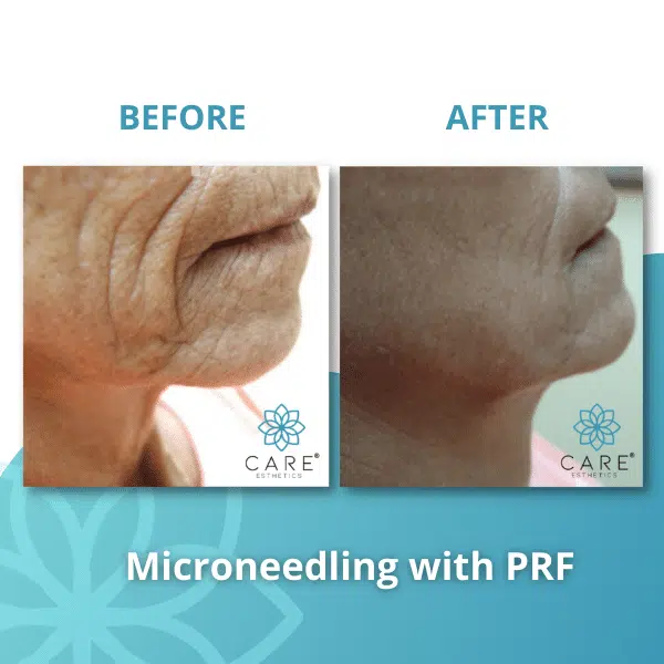 non-surgical-marionette-lines-correction-prf Non-surgical correction of marionette lines and deep wrinkles using PRF microneedling treatments showing drastic skin texture improvement