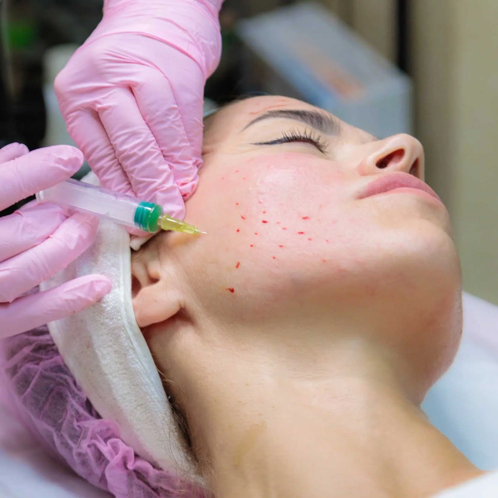 Close-up of a patient receiving a PRF injection for facial rejuvenation as part of the natural blood extraction and injection process