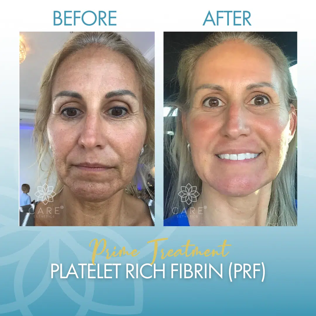 Before and after comparison of a patient showing skin rejuvenation and wrinkle reduction results from Bio-PRF treatment discussed in the FAQ