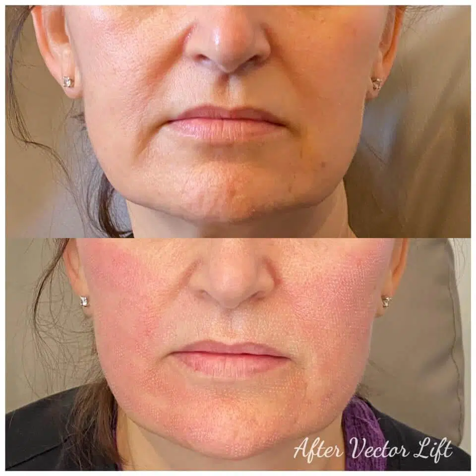 Close-up showing the benefits of Bio-LIFT protocol in tightening sagging jowls, diminishing fine lines, and firming the lower face naturally