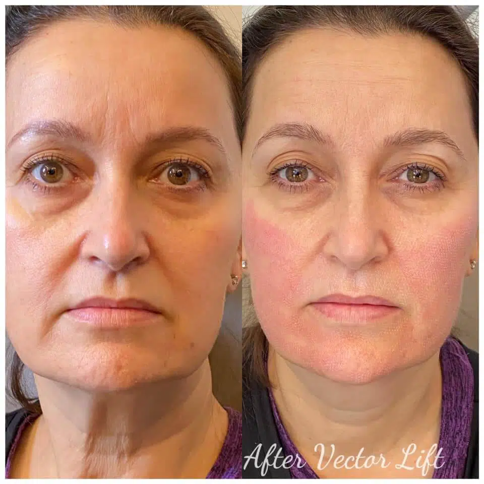 Before and after Bio-LIFT advanced biological rejuvenation treating under-eye hollows, sagging cheeks, and nasolabial folds