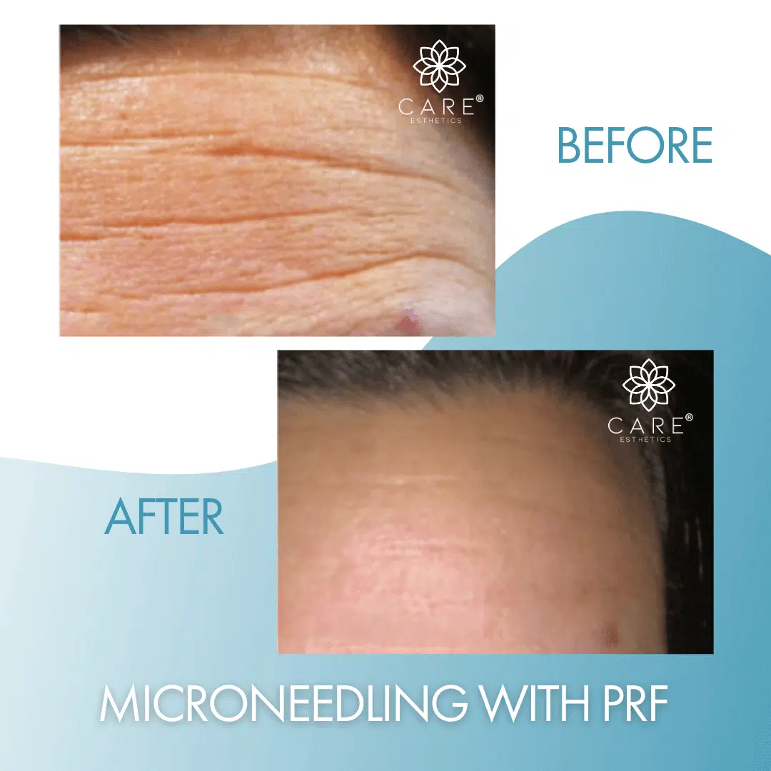 microneedling-prf-img.png Before and after comparison showing the reduction of deep forehead wrinkles using Microneedling with PRF to naturally smooth skin