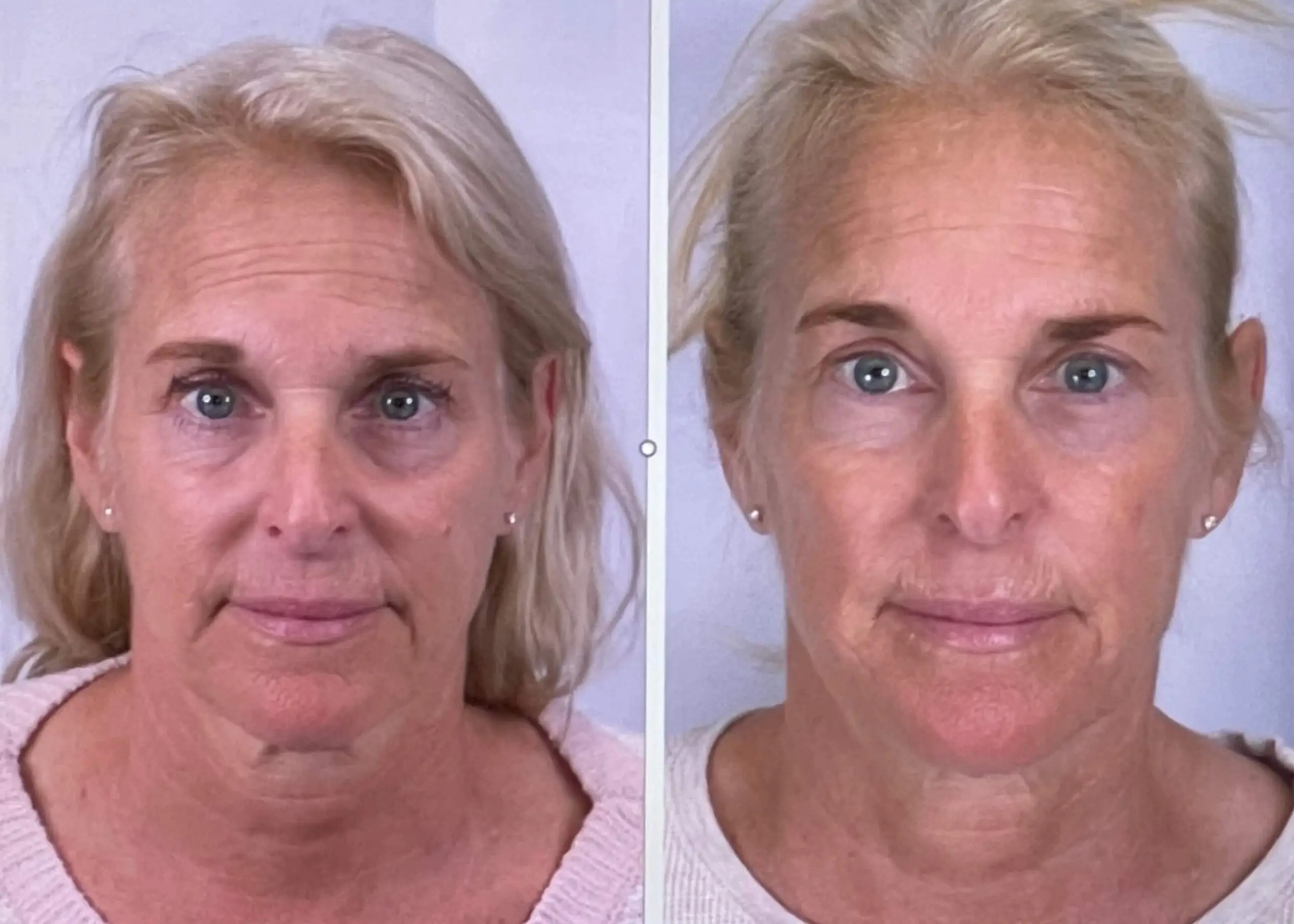 bio-regenerative-facial-rejuvenation-before-after Before and after comparison of bio-regenerative facial rejuvenation reducing signs of aging naturally