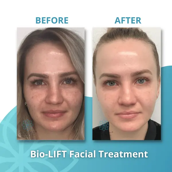 bio-lift-facial-skin-glow-texture-results Young woman showing obvious skin glow and texture improvement after one session of Bio-LIFT facial treatment