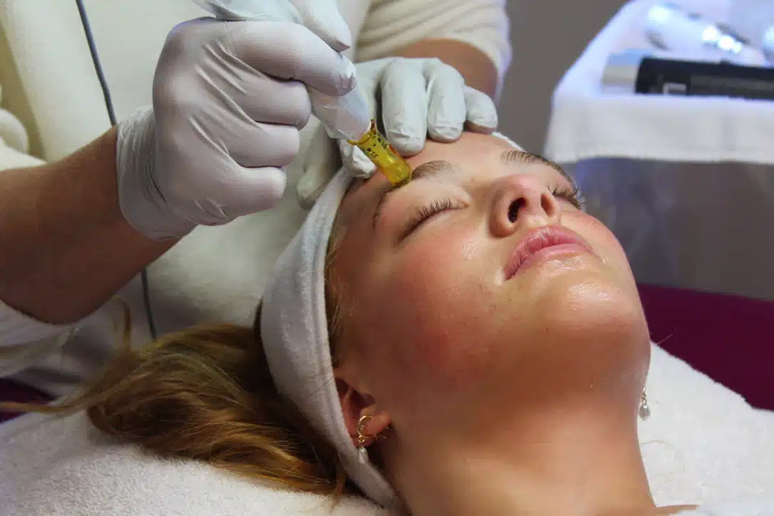 C8CFC4F2-EEA2-45A3-A8E1-B91E7C97A4CA_1_105_c Practitioner performing Microneedling with PRF treatment to naturally revitalize skin and treat acne scars, sun spots, and visible pores