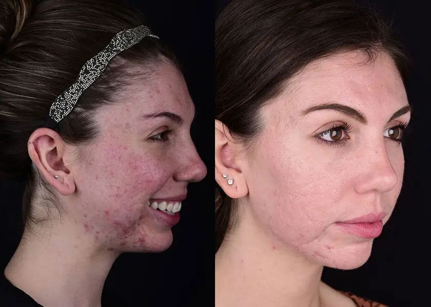 acne-scar-treatment-prf-results Side profile before and after photos showing acne scar reduction using PRF and microneedling therapy