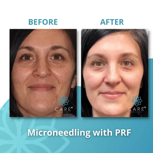 prf-microneedling-skin-tone-texture-results Before and after single PRF microneedling treatment showing massive improvement in skin tone, texture, and natural youthful glow