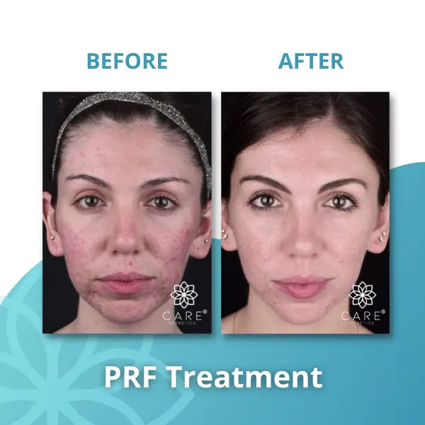 prf-treatment-acne-deep-scars-results Before and after PRF treatment showing massive improvement in deep acne scars, nasolabial folds, and under-eye circles