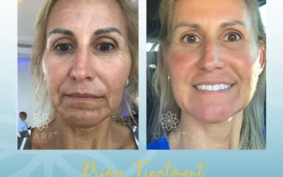 PRF Facial Rejuvenation: The Art of Natural Renewal