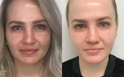 Why Choose PRP Injections for the Face: Regenerative Elegance Without Surgery